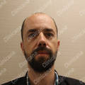 Before hair transplant