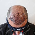 After hair transplant