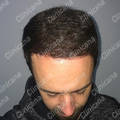 Result after hair transplant