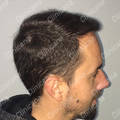 Result after hair transplant