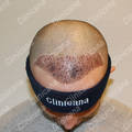 After hair transplant