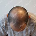 Before hair transplant