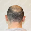 Donor area Before hair transplant