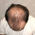 Before hair transplant