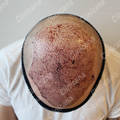 After hair transplant