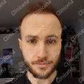 Result after hair transplant