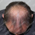 Before hair transplant