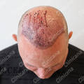 After hair transplant