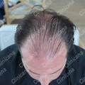 Before hair transplant