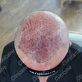 After hair transplant