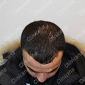 Result after hair transplant