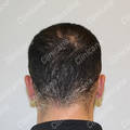 Result after hair transplant