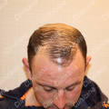 Before hair transplant