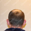 Before hair transplant