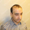 Avant la greffe de cheveux