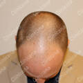 Före hårtransplantation