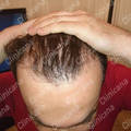 Before hair transplant