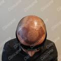 After hair transplant