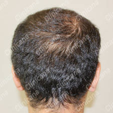 Avant la greffe de cheveux