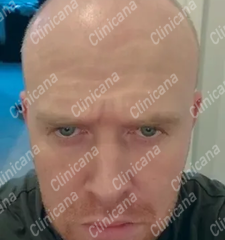 Преди трансплантация на коса Преди трансплантация на коса