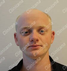 Avant la greffe de cheveux