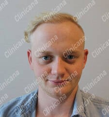 Après la greffe de cheveux