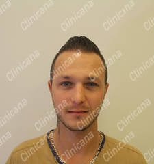 Après la greffe de cheveux