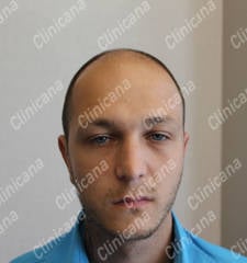 Avant la greffe de cheveux