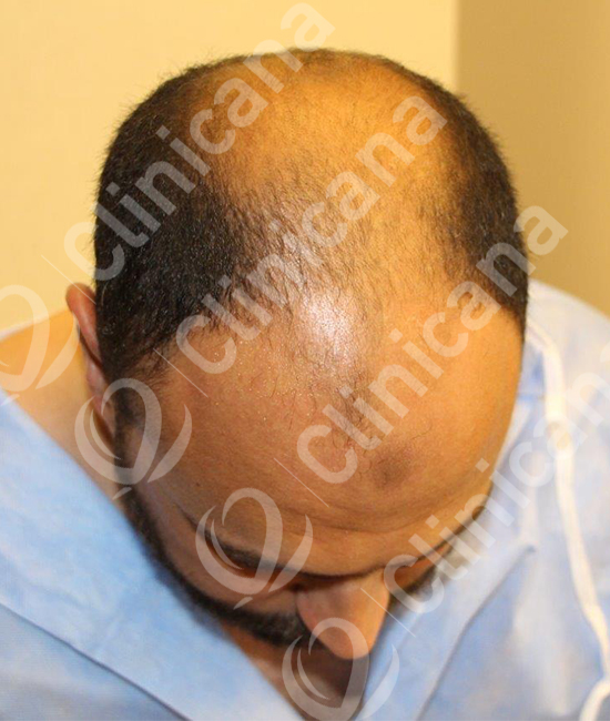 Hair Transplant Turkey FUE Hair Clinic Istanbul Clinicana