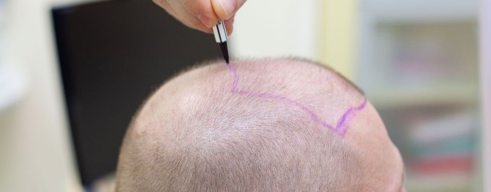 The Ultimate Hair Transplant Clinic Guide for a Successful Hair Transplant!