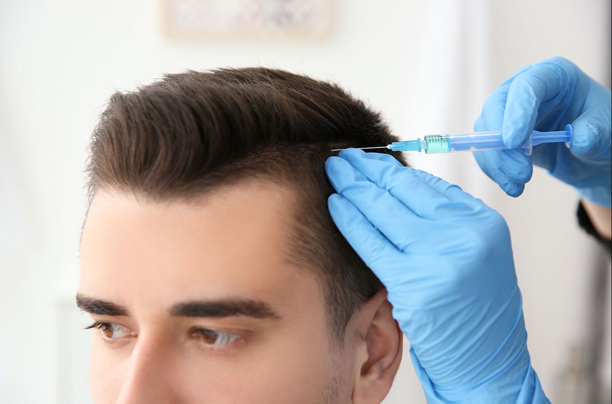 Triangular alopecia Causes and Treatment Clinicana