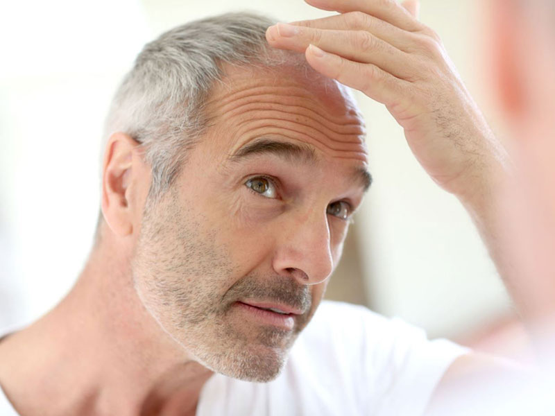 ▷ Hair Transplant with Grey Hair: Is it Possible? - Clinicana