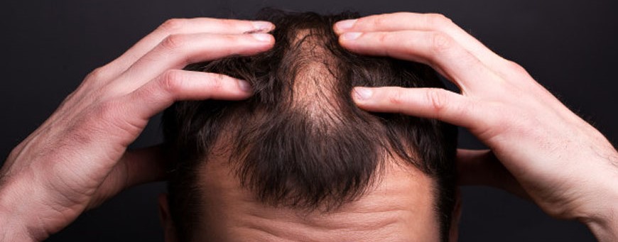 Causes, symptômes et traitement de la chute de cheveux et le psoriasis