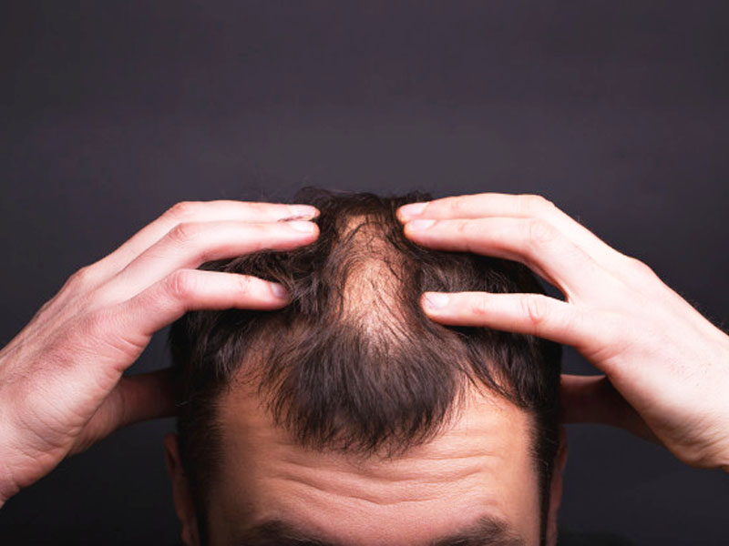 ▷ Psoriasis and Hair Loss: causes, symptoms &amp; treatment