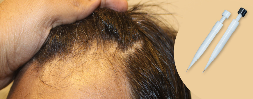 Dhi пересадка волос. Biofibre имплантация волос.