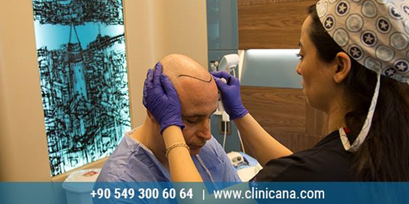 رسم الخط الأمامي لزراعة الشعر