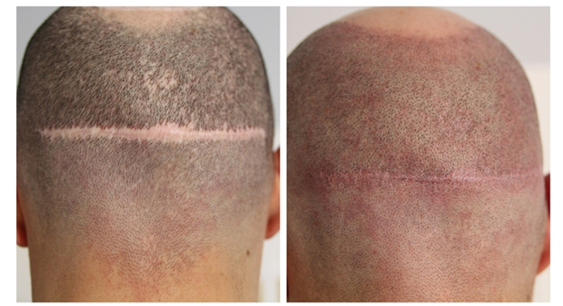 Микропигментация кожи головы для маскировки шрамов