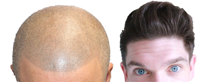 Mikropigmentierung Kopfhaut Micro Haarpigmen