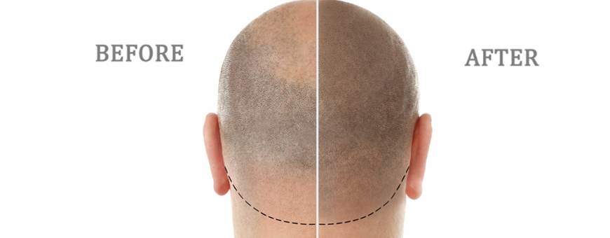 scalp micropigmentation reviews