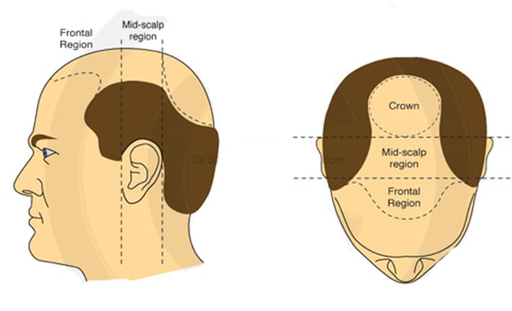 Hair Transplant Growth Chart