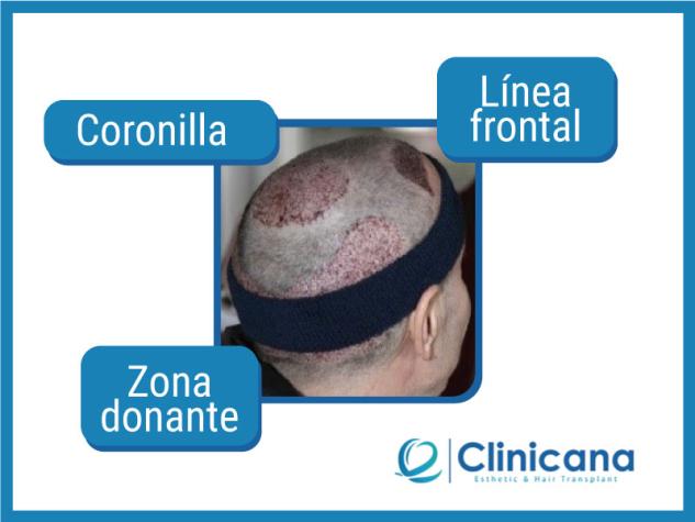 injerto de pelo del Maestro Joao