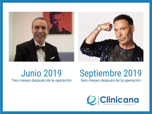 El Maestro Joado después del injerto de pelo