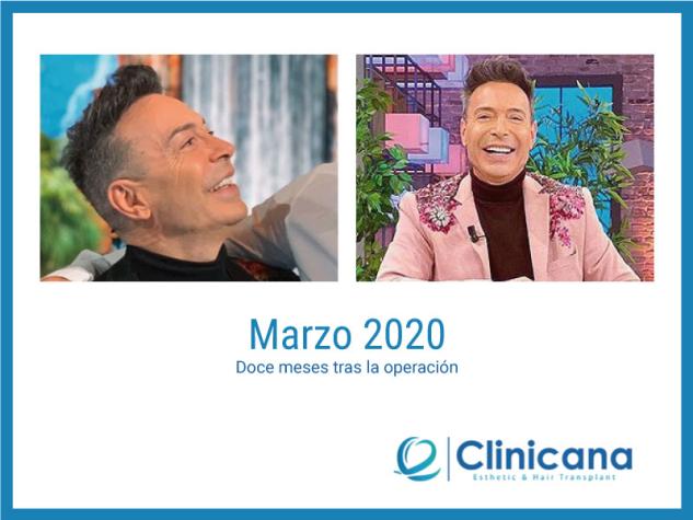 El Maestro Joao con pelo, antes y después