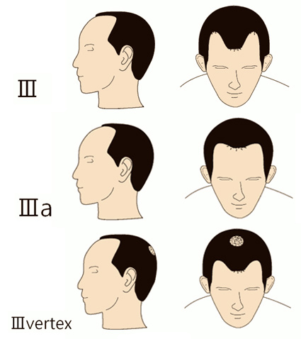 классификация гамильтона норвуда. норвуд облысение. норвуд облысение. шкала гамильтона-норвуда. шкала гамильтона-норвуда – степени облысения.