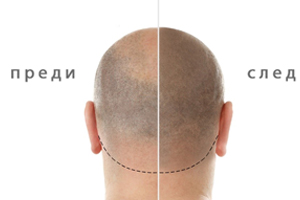 Микропигментация на скалпа