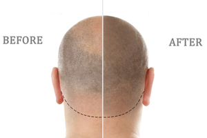 Микропигментация кожи головы: альтернативный вариант при алопеции