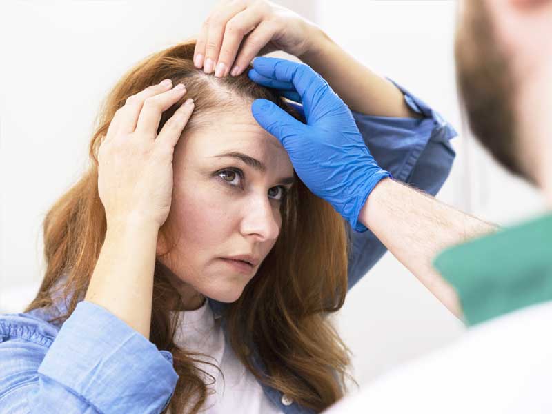 Alopecia androgénica en la mujer: ¿tiene tratamiento?