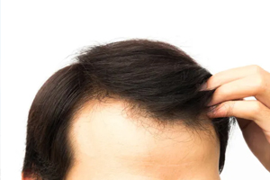 زراعة الشعر الإيطالي البايوفايبر او ما يسمى بالشعر الصناعي