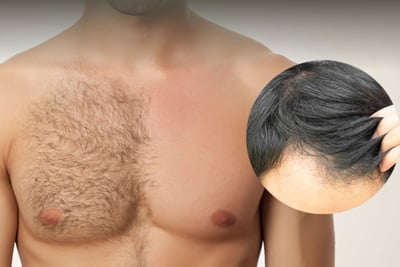 Transplant de păr (din piept şi barbă) prin tehnica FUE