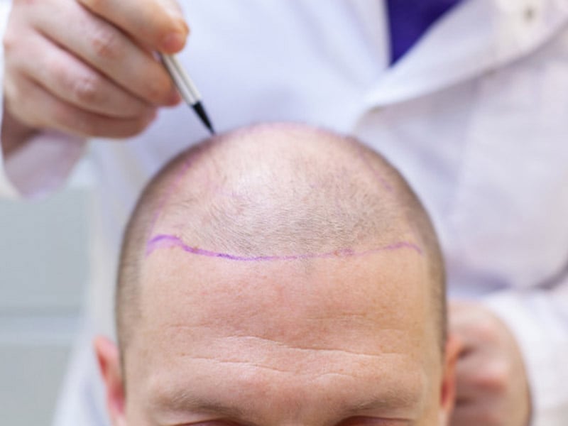 La survie des greffons dépend de quels facteurs?